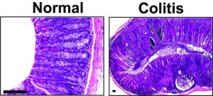 Caption: Images under a microscope reveal a normal mouse colon (left) and a mouse colon with colitis (right). Note in the diseased colon the additional thickness in mass of the lining due to severe inflammation and cancer development. The images of the diseased colon were taken of an animal from a unique mouse strain developed by the researchers that mimics early-onset ulcerative colitis in humans and may be helpful for testing new drugs and other therapies. Credit: The journal Gastroenterology/UCLA