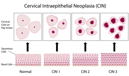 Cervical Neoplasia