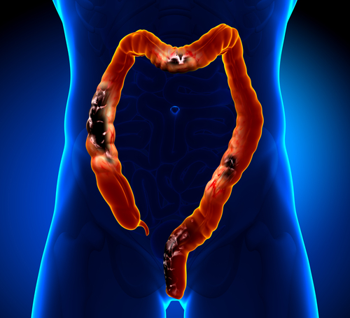 Ulcerative Colitis Patients in UK Unsatisfied with Treatment