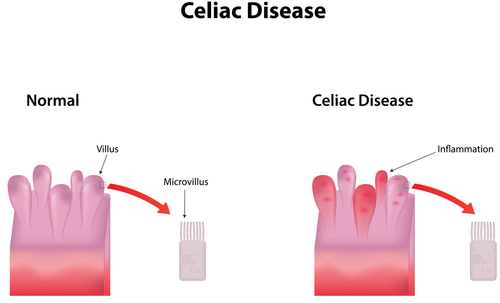 New Celiac Disease Panel Offers Promising, New Diagnostic Tools To Aid Doctors, Patients