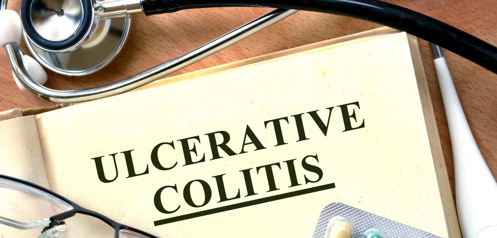 Ulcerative Colitis Disease Activity: Rectosigmoidoscopy Strongly Correlates With Colonoscopy Results
