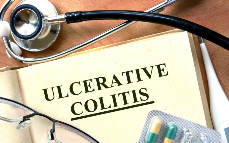 Ulcerative colitis study