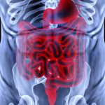 $9.7 million NIH grant to study Crohn's disease