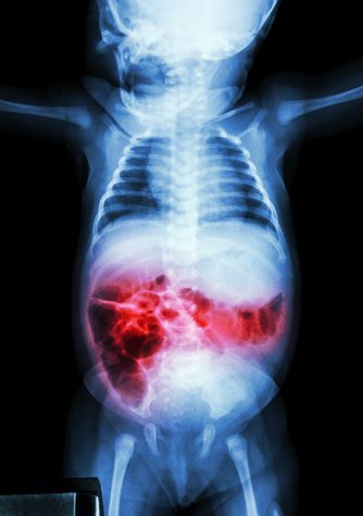 inflammation in the bowel
