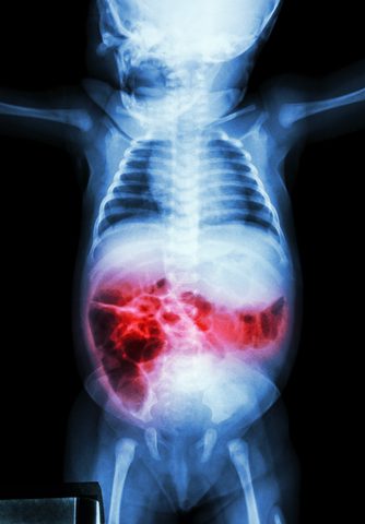 Drug May Aid in Diagnosing via Scans IBD and Other Inflammatory Diseases
