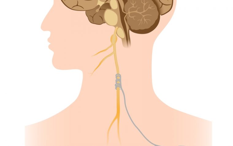 Vagus nerve and inflammatory bowel disease